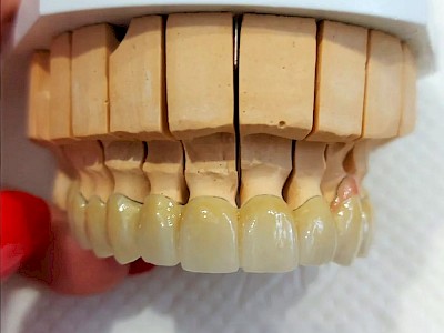 Zirconia Crown